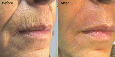 CO2 Laser Perioral Wrinkles Before and After